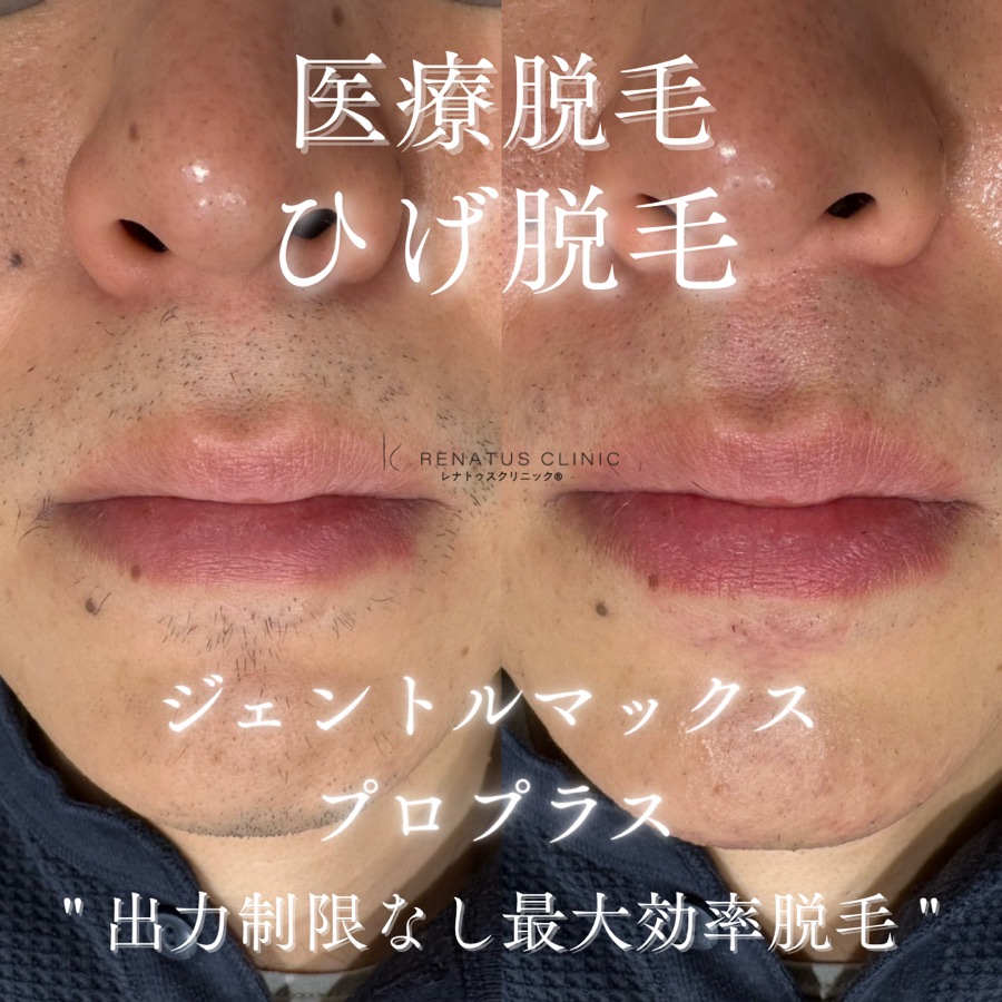 ヒゲ脱毛 症例写真