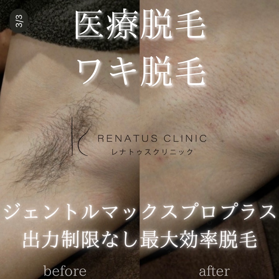 ワキ脱毛 施術症例写真