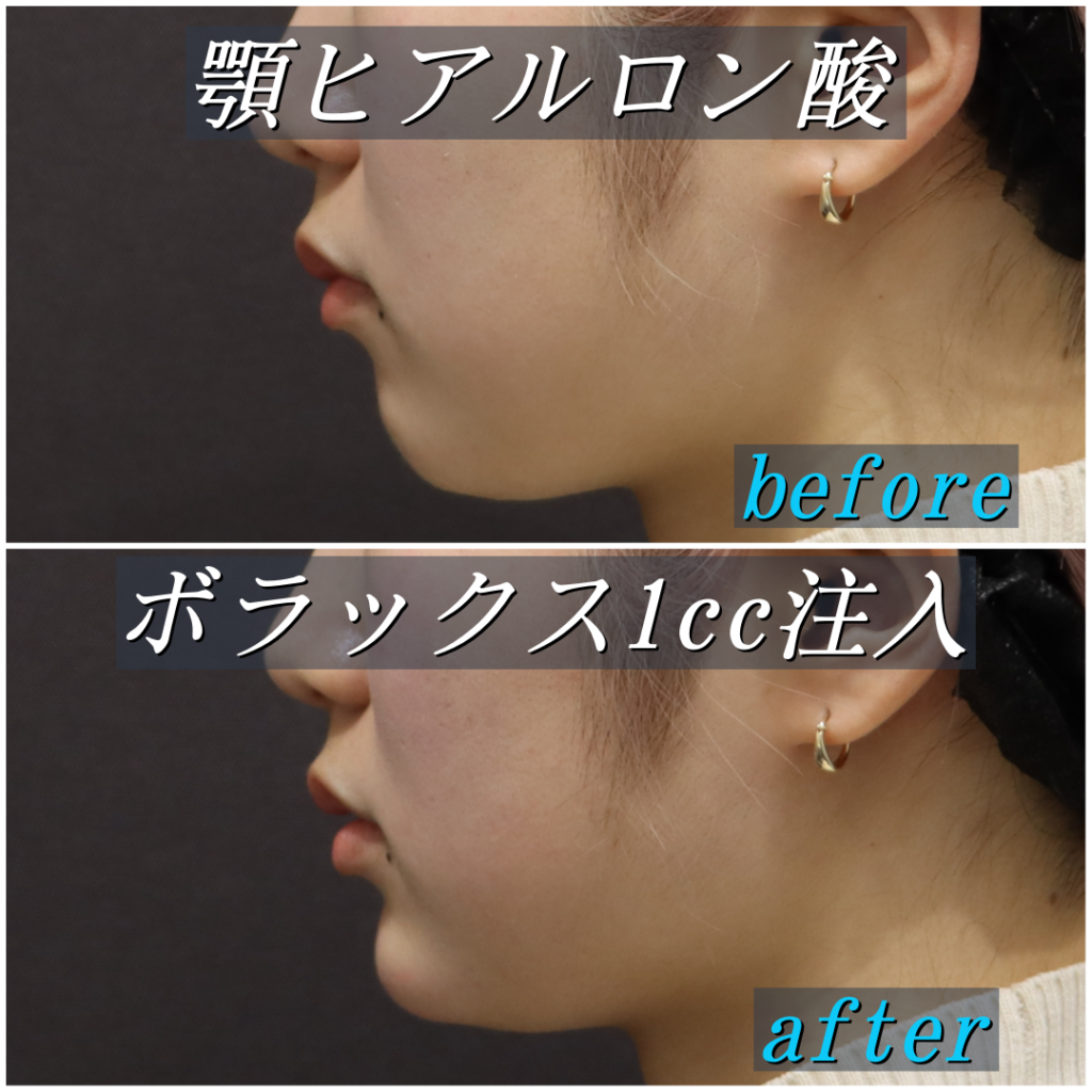 顎ヒアルロン酸1cc注入時の変化(左横)